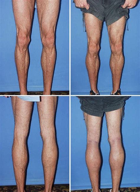 Calf Implants Dr G Cosmetic Surgery Cosmetic Surgery Implants