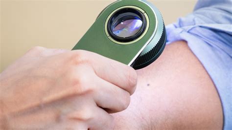 Preauricular lymph node metastasis was also present. Best Skin Cancer Specialist Uk - Skin Cancer