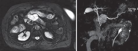 Magnetic Resonance Cholangiopancreatography Mrcp 45 Mm Hypervascular