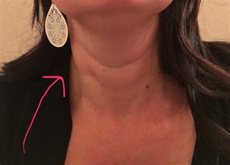 Goiter But Everything Is Normal Thyroid Disease Forum