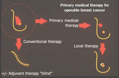 Preoperative/neoadjuvant medical therapy for early breast cancer - The