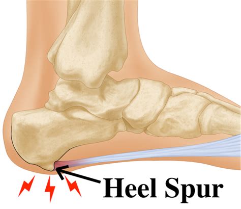 Bone Spurs Of The Heel Of Foot Defined And Treatments