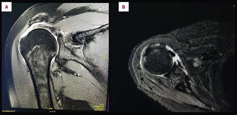 A Right Shoulder Magnetic Resonance Imaging Without Contrast Coronal
