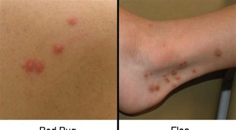 Flea Bites Vs Bed Bug Bites What To Do If You Infested With The Bugs