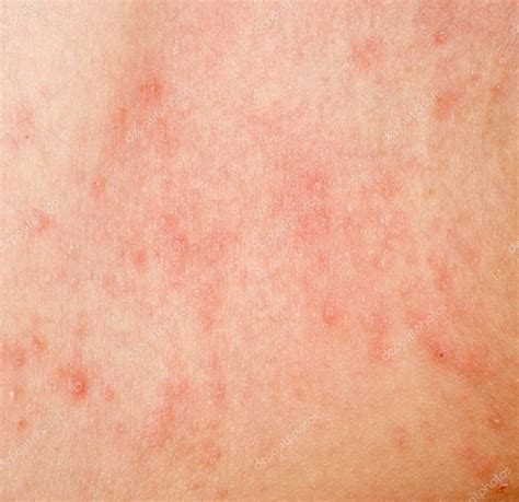 Allergic Rash Dermatitis Skin Texture — Stock Photo © Panxunbin 6947071