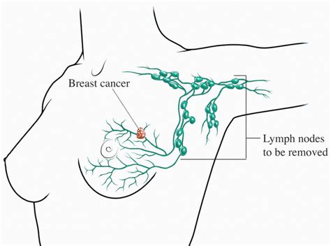 Lymph Nodes In Armpit Diagram