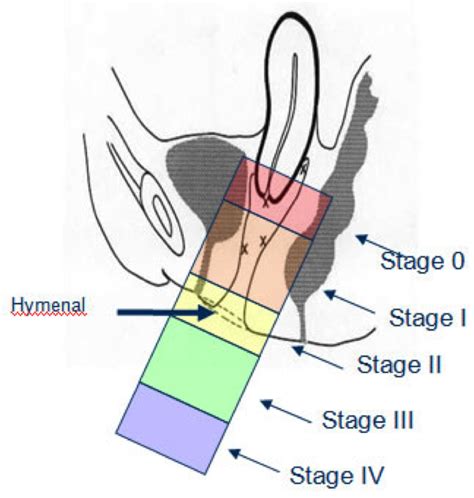 Pelvic Organ Prolapse Stages
