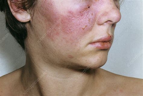 lupus erythematosus on the face stock image c013 1028 science photo library