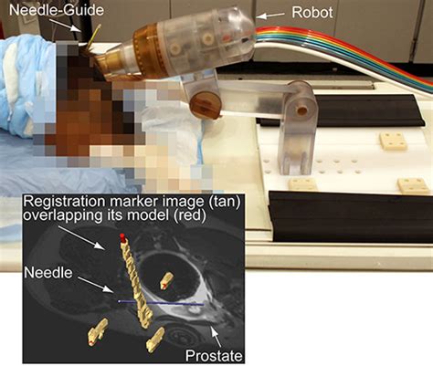 Urobotics Robots In Urology Johns Hopkins Medicine