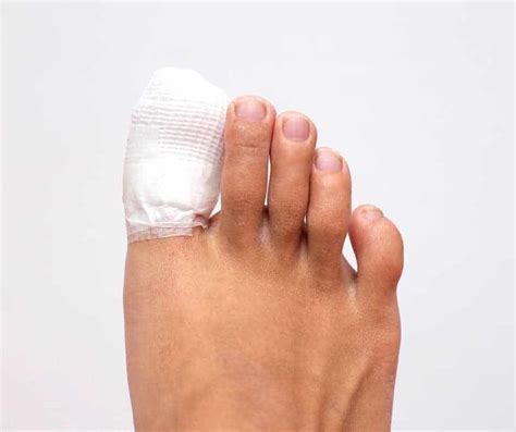 Toenail Removal Everything You Need To Know Northwich Foot Clinic