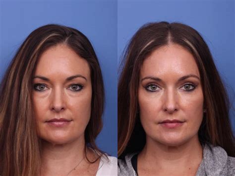 Blepharoplasty Before And After Pictures Case 319 Scottsdale Az Hobgood Facial Plastic