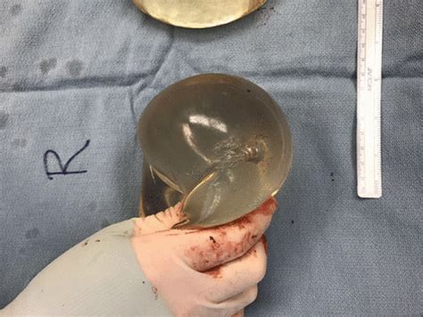 Womans Breast Implant Saves Her Life By Blocking A Bullet
