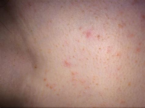 Yellow Pores And Small Bumps On Breasts And Chest With Picture Back