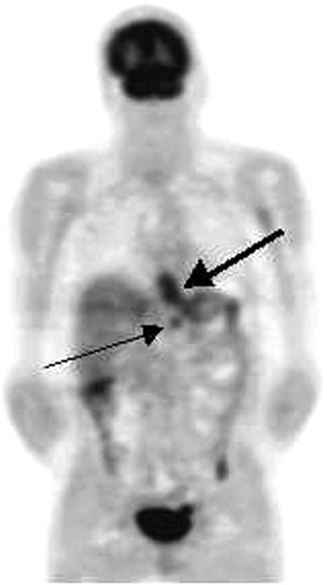 Detection Of Distant Metastases In Esophageal Cancer With 18f Fdg Pet