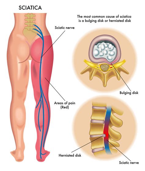 Acupuncture For Sciatica — Morningside Acupuncture Nyc