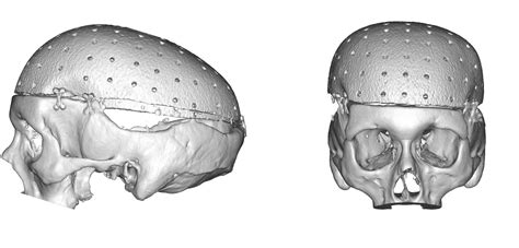 Blog Archivecase Study Total Skull Implant With Onlay Cranioplasties