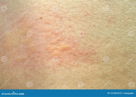 Éruption Cutanée Urticaria Réaction Allergique De Peau Image Stock