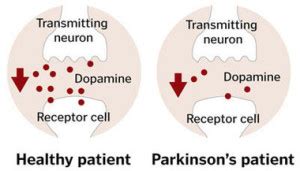 Parkinson's disease answers are found in the nutrition guide for clinicians powered by unbound dopamine agonists (bromocriptine, pramipexole, ropinirole, rotigotine, and apomorphine) improve dairy foods intake and risk of parkinson's disease: Parkinson's Disease : Causes, Symptoms and Treatment
