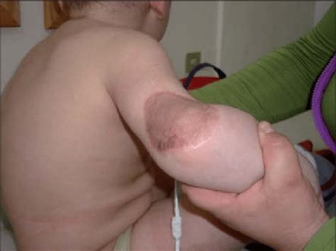 Nathalie quiroz1, janeth del pilar villanueva2, edgar andrés lozano3. Mucormicosis cutánea tratada y curada, sometida a injerto ...