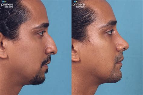 Rhinoplasty Before And After Pictures Case 55 Orlando Florida
