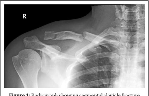 Figure 1 From Segmental Clavicle Fracture With Acromioclavicular Joint