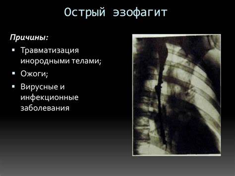 Острый эзофагит диета Рентгенанатомия и рентгенпатология желудочно-кишечного тракта Рентгенанатомия и рентгенпатология желудочно-кишечного тракта Острый эзофагит диета