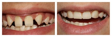 Brilliant composite bonding results from £250 per tooth