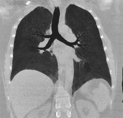Lung Cysts And Mid And Upper Lobe Infiltrates In Biopsy Proven