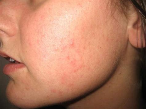 Red Bumps On My Face Dorothee Padraig South West Skin