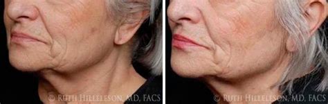 Thermage Skin Tightening Photos Richmond Va Patient 5035