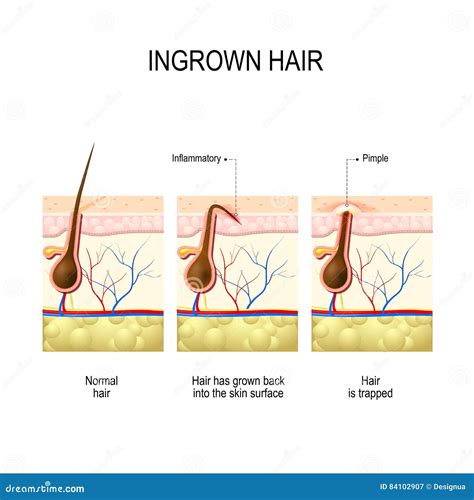 Ingrown Hair after Hair Removal and Shaving Stock Vector - Illustration