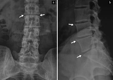 Ap Lumbar Spine Xray Radiology Imaging Diagnostic Ima