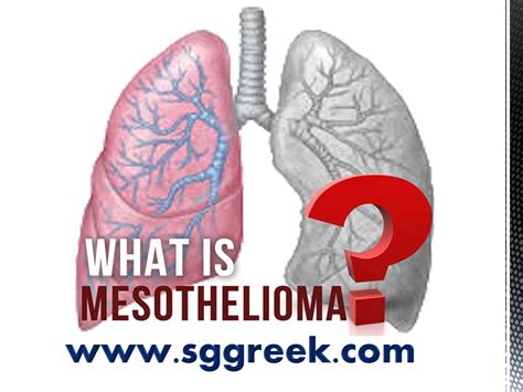 What Is Mesothelioma How To Identify Symptoms Causes And Treatment