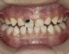 Silver Diamine Fluoride Toxicity