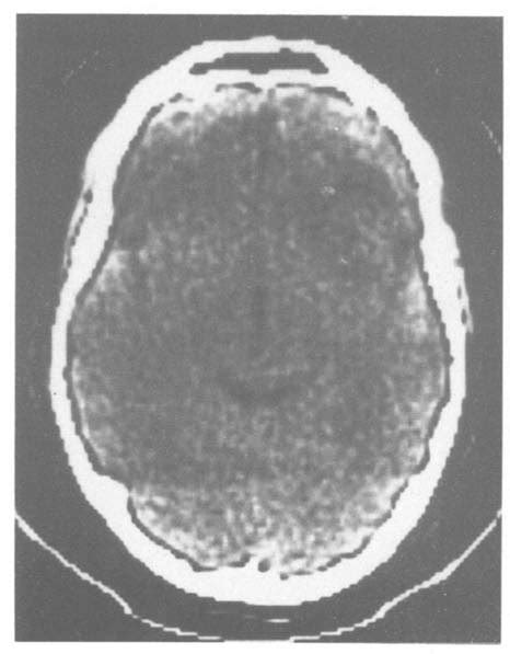 Case 1 Unenhanced Ct Scan Showing A Low Attenuation Lesion In The