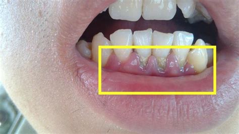 牙齦發黑是怎麼回事？小心這四點，是其中一種都要注意了！ 每日頭條