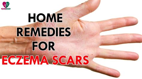 Home Remedies For Eczema Scars Health Sutra Youtube