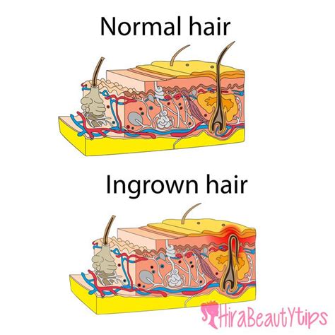 An ingrown hair cyst is a hair follicle cyst. 22 best INGROWN HAIR REMEDY images on Pinterest | Ingrown ...