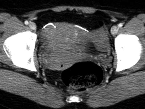 Multimodality Imaging Of The Essure Tubal Occlusion Device Clinical