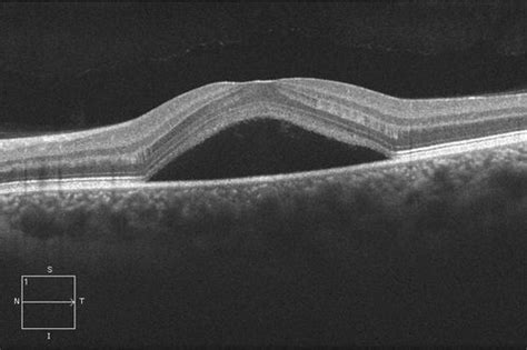 Central Serous Retinopathy Csr