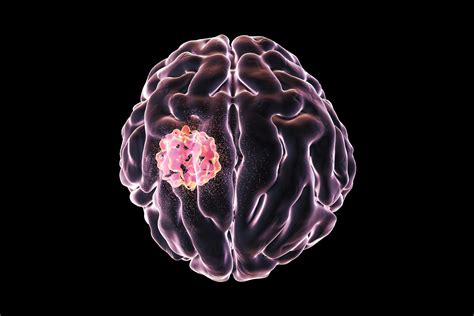 Brain Cancer Types What Are The Most Common Forms Of Brain Cancer