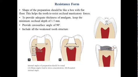 Operative Dentistry Lec 4 Cavity Preparation Of Cl 1 For Amalgam