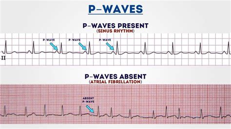 How To Read An Ecg Ecg Interpretation Geeky Medics Ecg