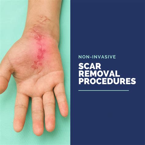 Non Invasive Scar Removal Procedures Annapolis And Severna Park Md
