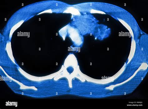Pulmonary Tuberculosis Ct Scan Stock Photo Alamy