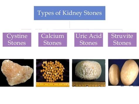 Kidney Stones Your Kid
