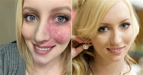 Blogger Rachel Anderson Spent Years Hiding Birthmark Finally