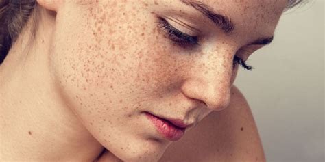 Everything You Need To Know About Getting Rid Of Freckles Vdg Anti