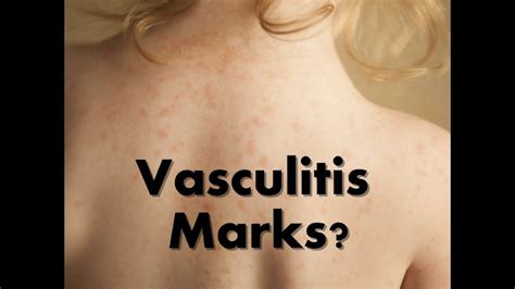 How To Cure Vasculitis Home Remedies For Vasculitis Youtube
