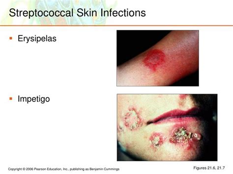 Streptococcal Skin Infections Pictures Pictures Photos